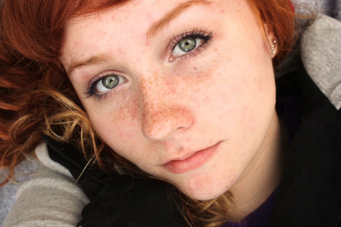 freckles050